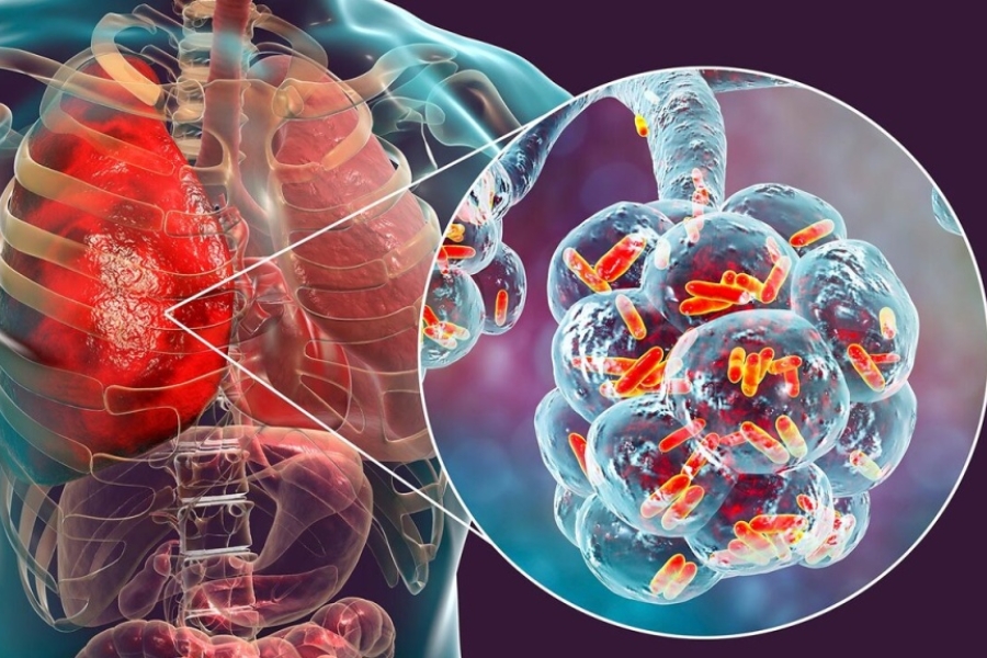 Viem-phe-quan-cap-tinh