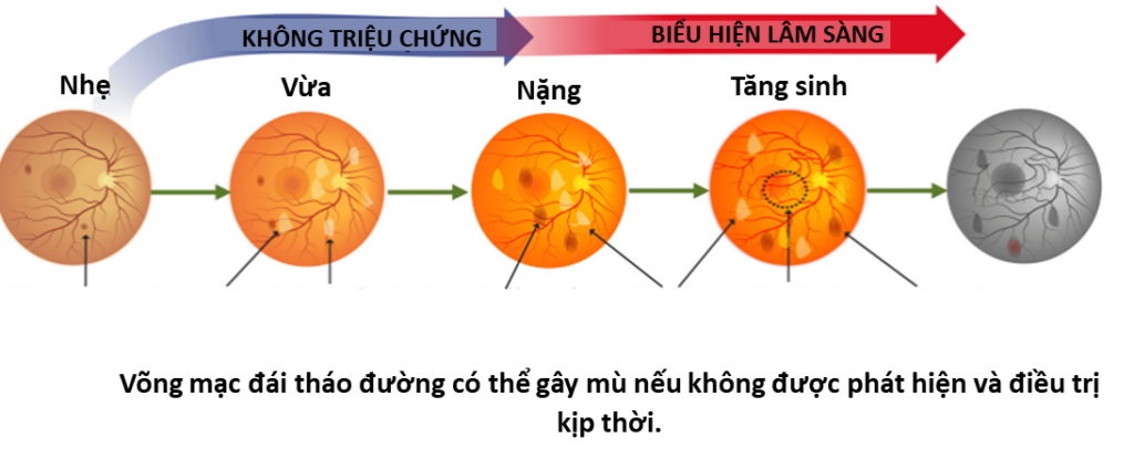 Bệnh võng mạc đái tháo đường có gây mù không?