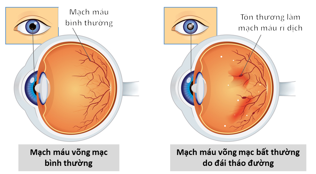 Đái tháo đường ảnh hưởng đến mắt như thế nào?