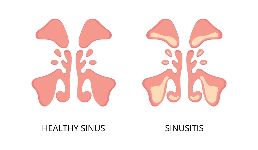 Viêm mũi xoang là viêm mũi và các xoang cạnh mũi