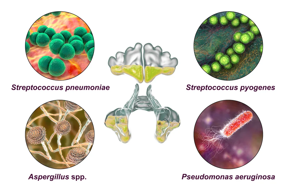 Một số vi khuẩn gây viêm mũi xoang