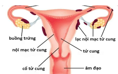 Lạc nội mạc tử cung là bệnh gì