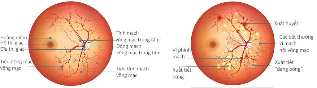 Bệnh võng mạc đái tháo đường